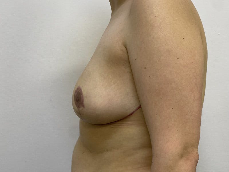Breast Reduction  Before & After Gallery - Patient 122371410 - Image 2
