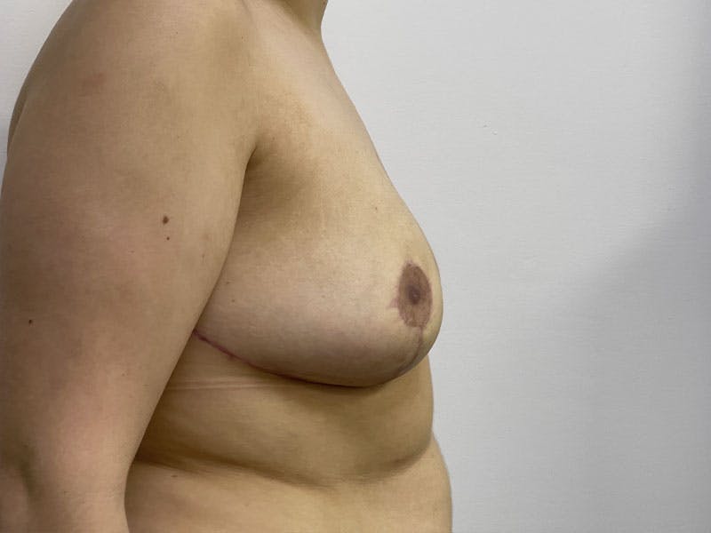 Breast Reduction  Before & After Gallery - Patient 122371410 - Image 4