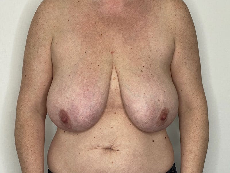 Breast Reduction  Before & After Gallery - Patient 122371411 - Image 1