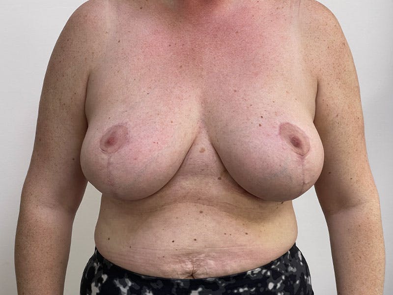 Breast Reduction  Before & After Gallery - Patient 122371411 - Image 2