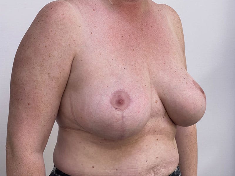 Breast Reduction  Before & After Gallery - Patient 122371411 - Image 4