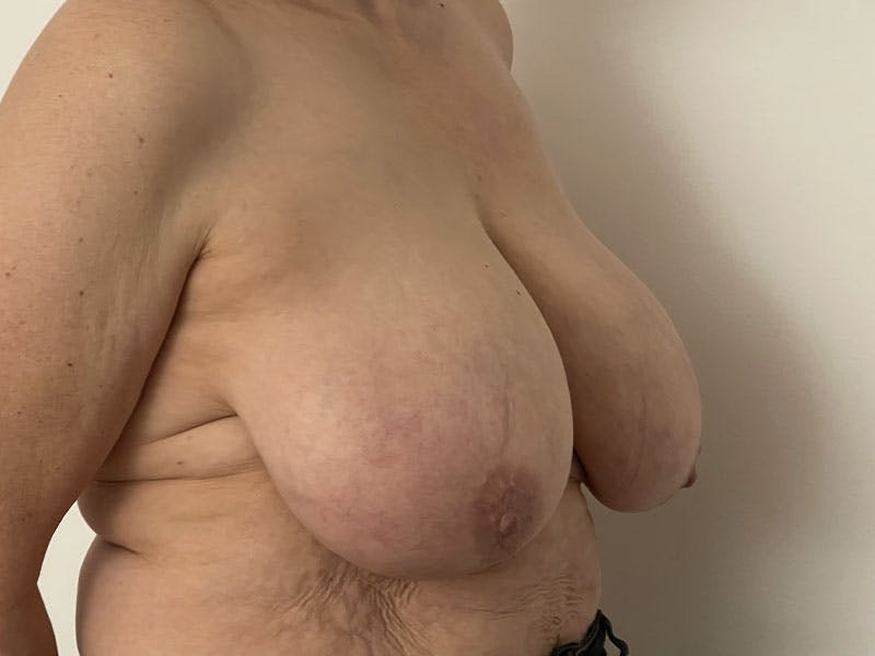 Breast Reduction  Before & After Gallery - Patient 122371412 - Image 1