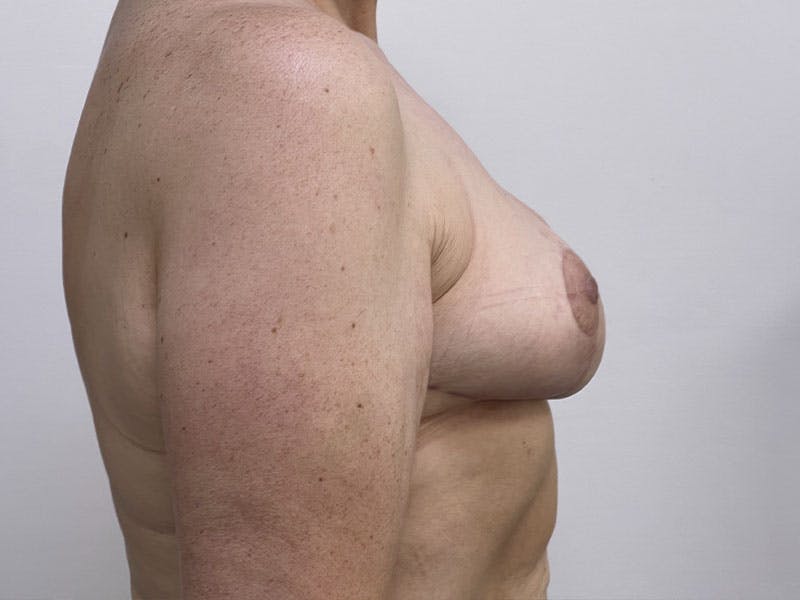 Breast Reduction  Before & After Gallery - Patient 122371412 - Image 2
