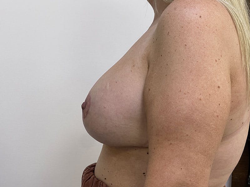 Breast Reduction with Implants Before & After Gallery - Patient 122389242 - Image 2