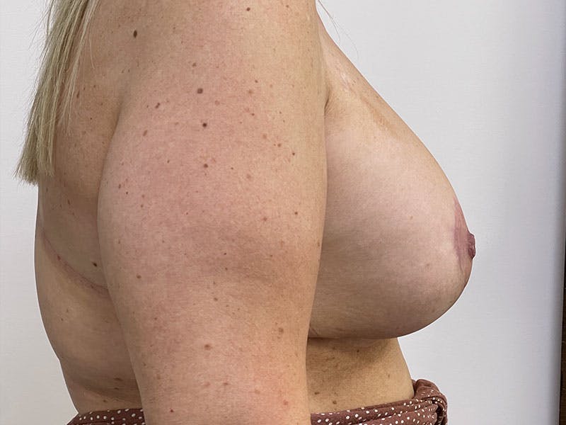 Breast Reduction with Implants Before & After Gallery - Patient 122389242 - Image 4