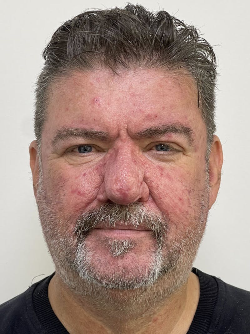 CO2 Laser Resurfacing Before & After Gallery - Patient 122389246 - Image 2