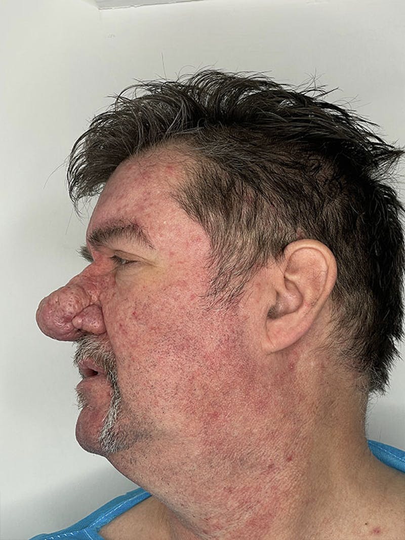 CO2 Laser Resurfacing Before & After Gallery - Patient 122389246 - Image 3