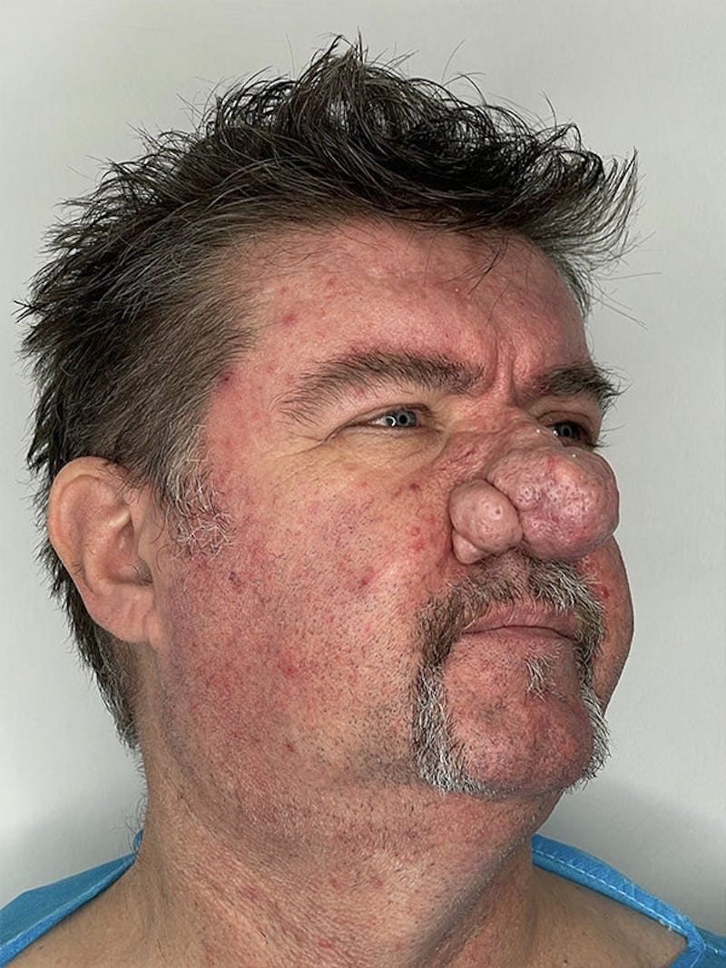 CO2 Laser Resurfacing Before & After Gallery - Patient 122389246 - Image 5