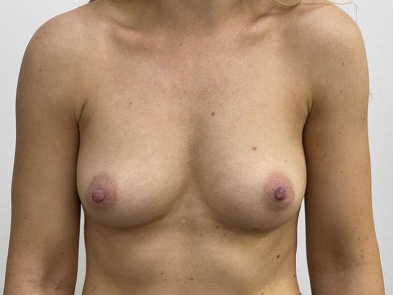 Fat Transfer Breast Enlargment Before & After Gallery - Patient 122389253 - Image 2