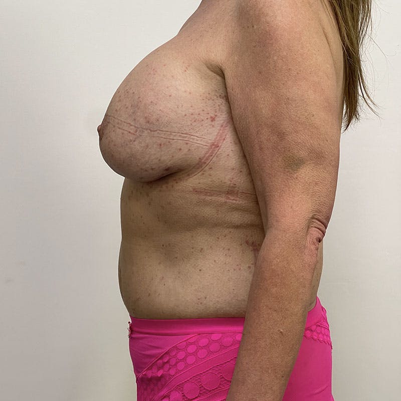 Mummy Makeover Before & After Gallery - Patient 122389262 - Image 4