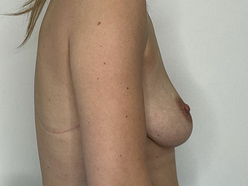 Breast Uplift with Implants Before & After Gallery - Patient 122389274 - Image 1