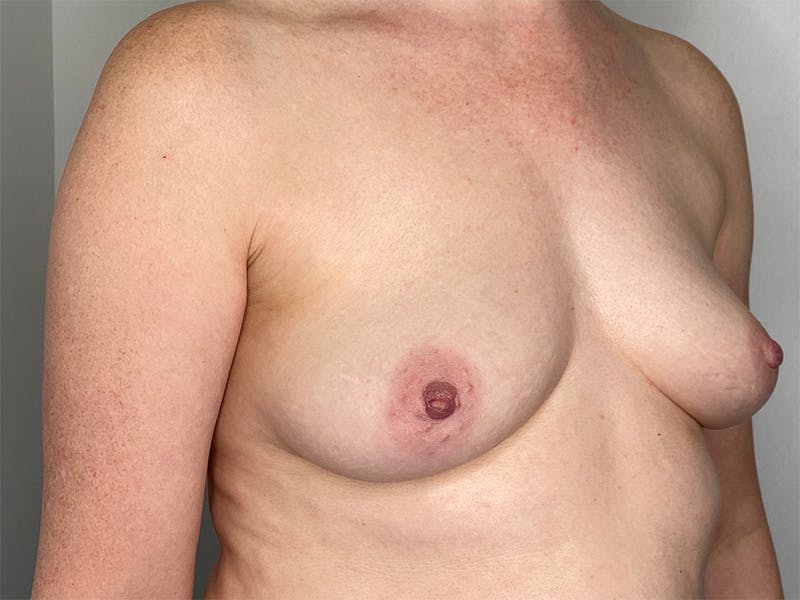 Breast Augmentation Before & After Gallery - Patient 141596499 - Image 3