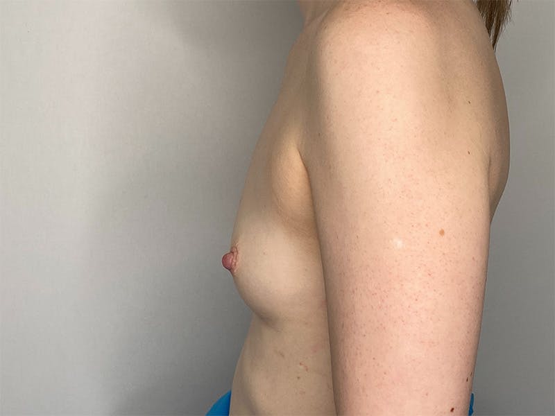 Before and after breast augmentation in Glasgow 2