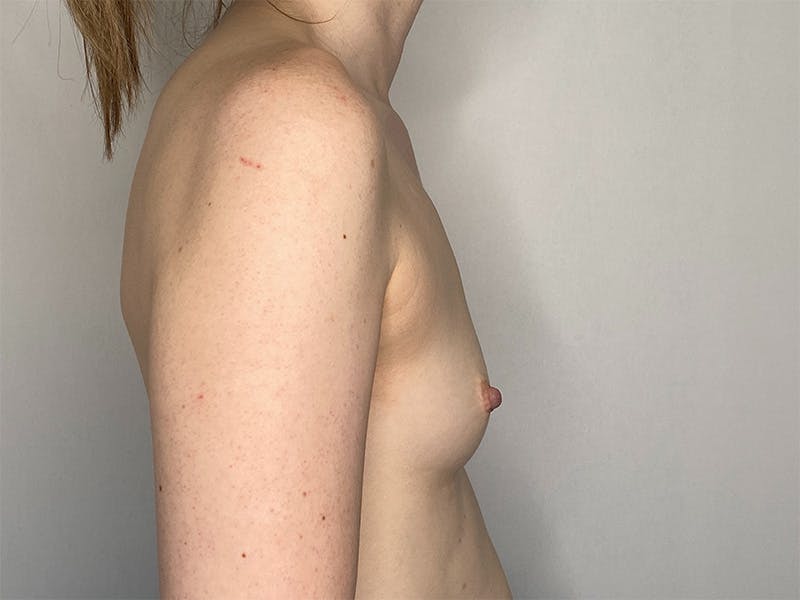 Breast Augmentation Before & After Gallery - Patient 141596527 - Image 3