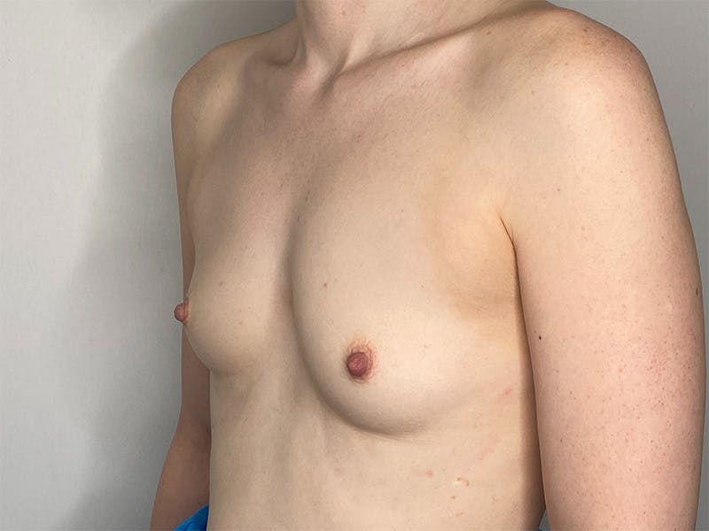 Breast Augmentation Before & After Gallery - Patient 141596527 - Image 5