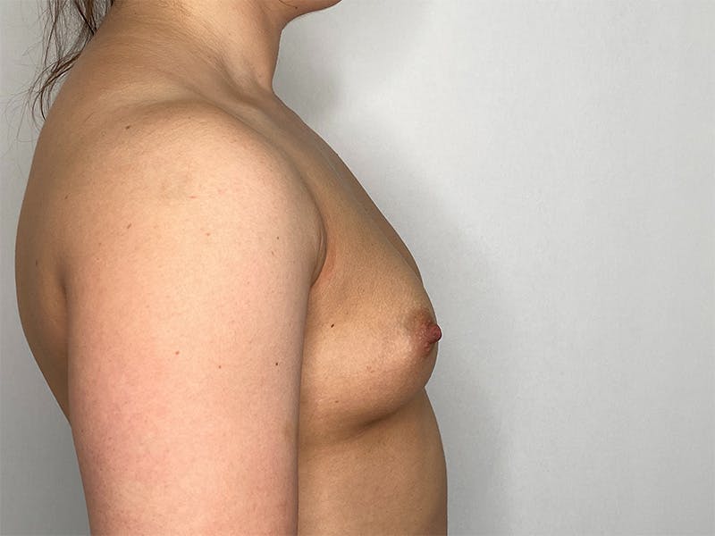 Breast Augmentation Before & After Gallery - Patient 141596526 - Image 1