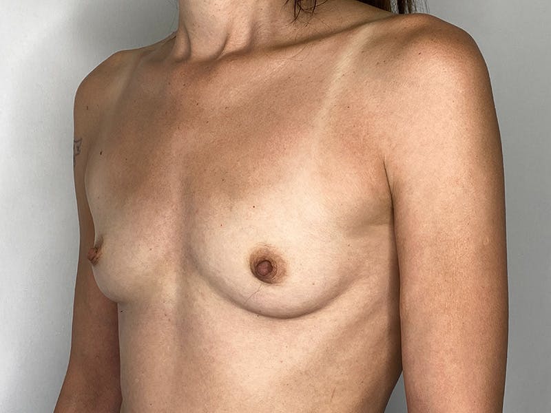 Breast Augmentation Before & After Gallery - Patient 141596525 - Image 3