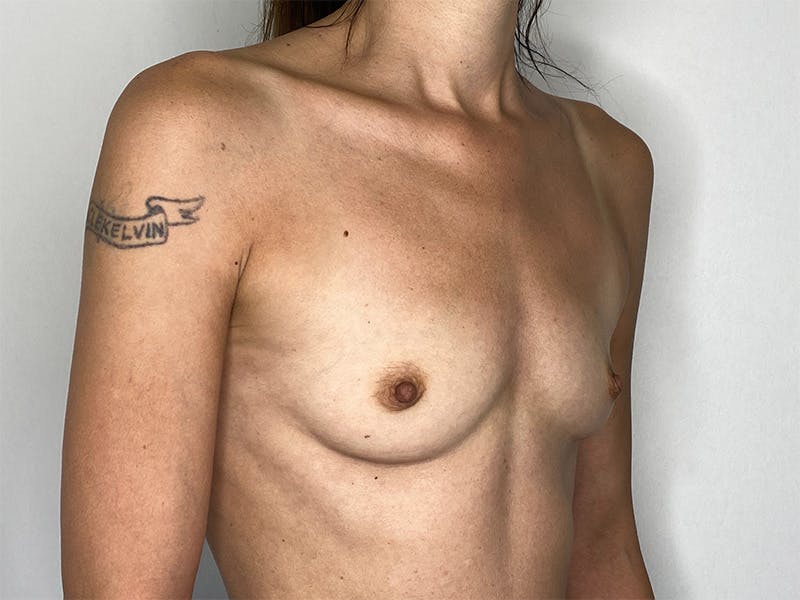 Breast Augmentation Before & After Gallery - Patient 141596525 - Image 5