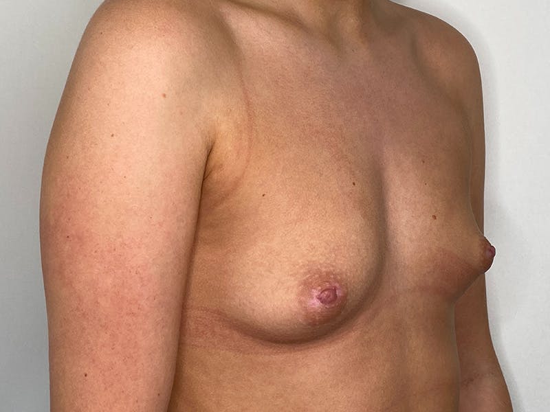 Breast Augmentation Before & After Gallery - Patient 141596524 - Image 1
