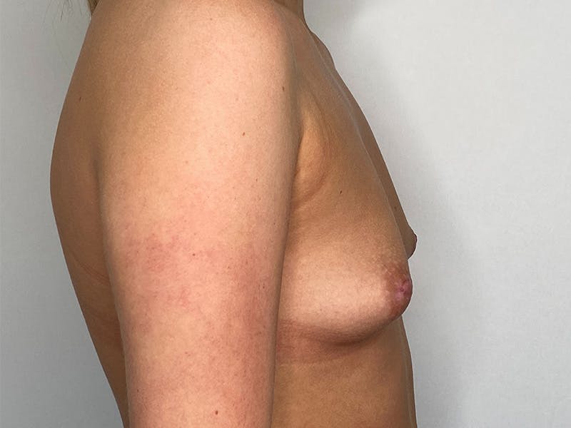Breast Augmentation Before & After Gallery - Patient 141596524 - Image 3