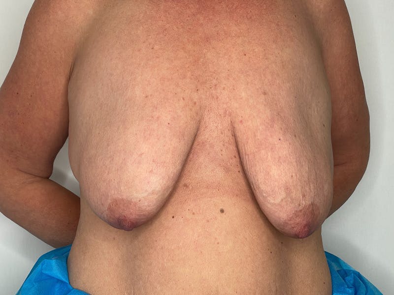 Breast Uplift with Implants Before & After Gallery - Patient 141596634 - Image 1