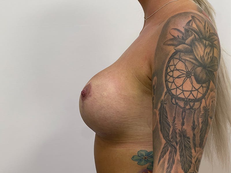 Breast Uplift with Implants Before & After Gallery - Patient 141596633 - Image 4