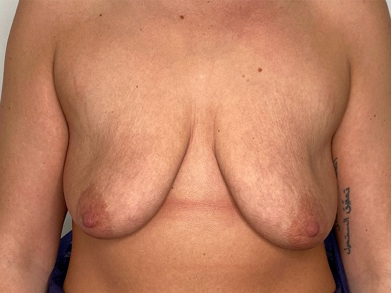 Breast Uplift with Implants Before & After Gallery - Patient 141596632 - Image 1