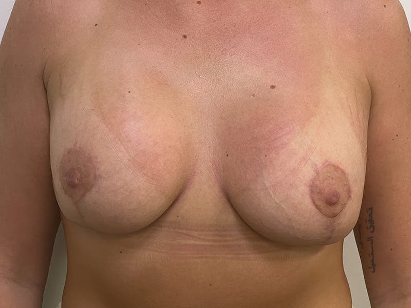 Breast Uplift with Implants Before & After Gallery - Patient 141596632 - Image 2