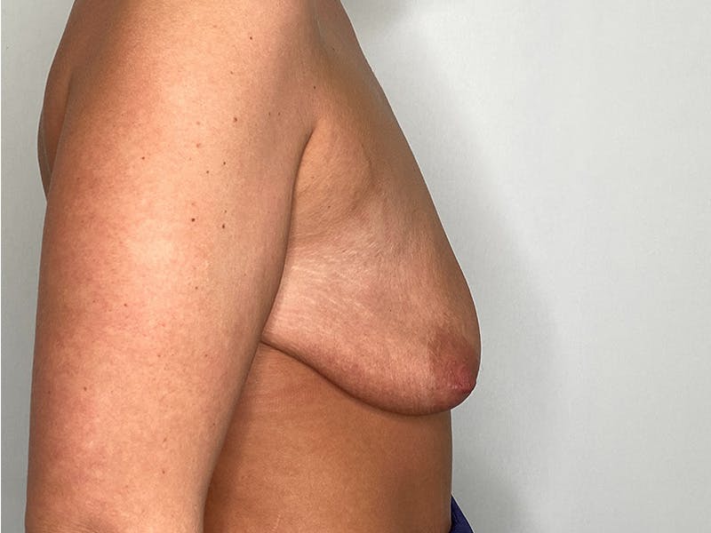 Breast Uplift with Implants Before & After Gallery - Patient 141596632 - Image 3