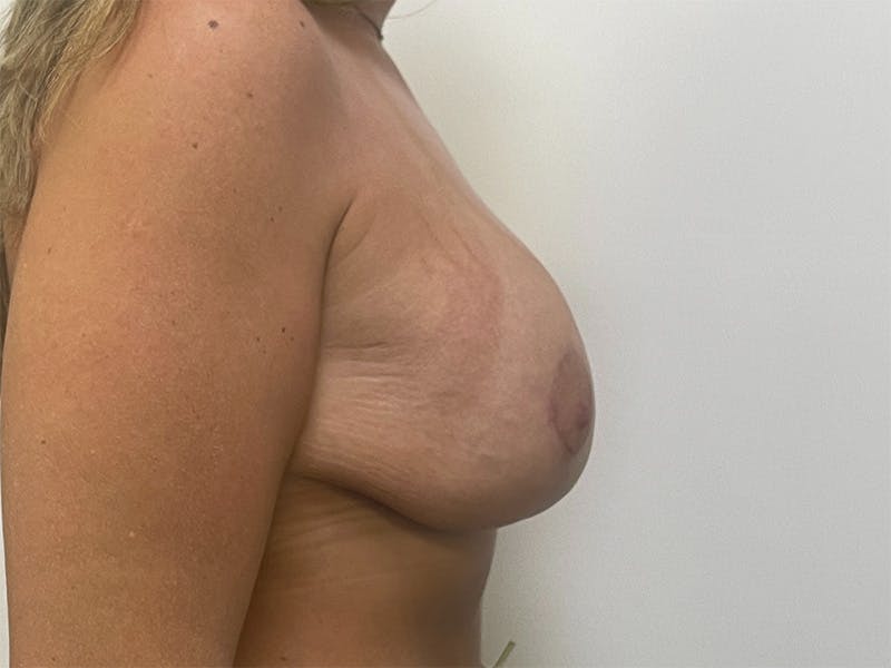 Breast Uplift with Implants Before & After Gallery - Patient 141596632 - Image 4