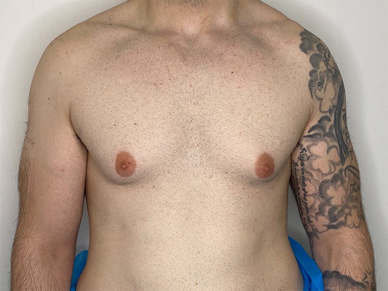 Gynecomastia (Male Breast Reduction) Before & After Gallery - Patient 141597219 - Image 1