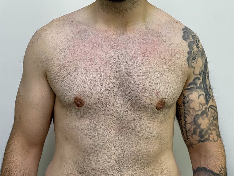 Gynecomastia (Male Breast Reduction) Before & After Gallery - Patient 141597219 - Image 2