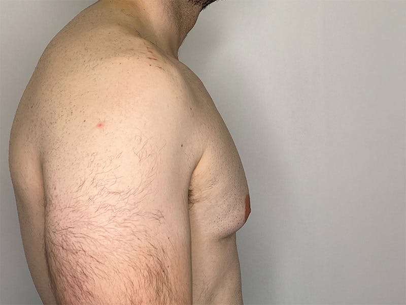 Gynecomastia (Male Breast Reduction) Before & After Gallery - Patient 141597219 - Image 3