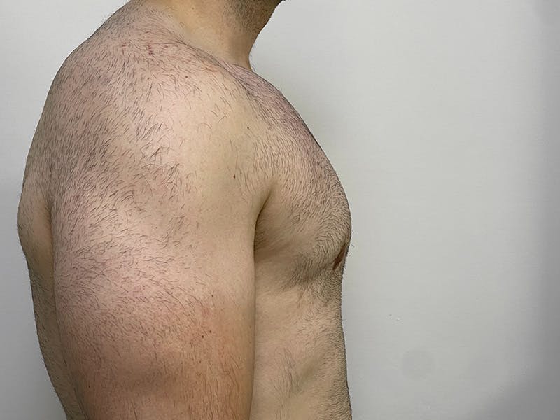 Gynecomastia (Male Breast Reduction) Before & After Gallery - Patient 141597219 - Image 4