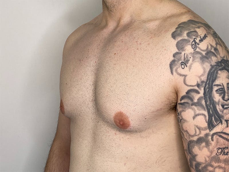 Gynecomastia (Male Breast Reduction) Before & After Gallery - Patient 141597219 - Image 5