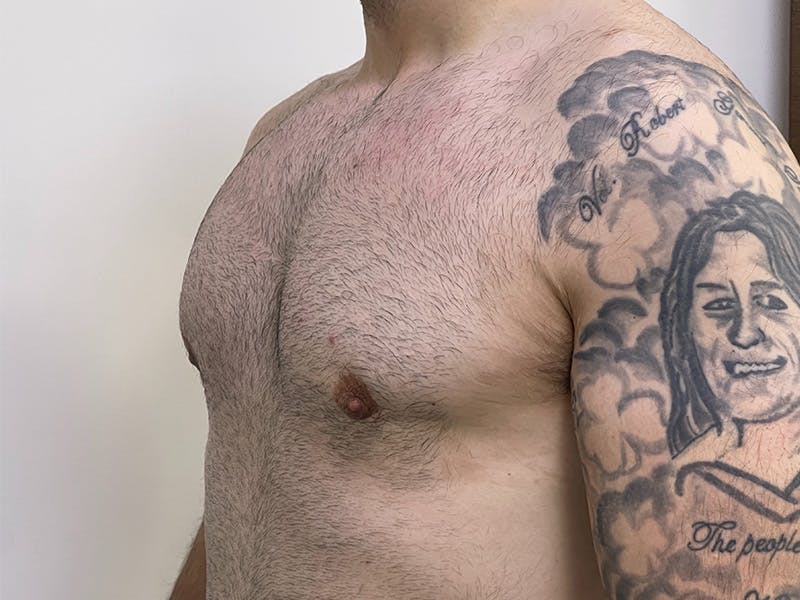 Gynecomastia (Male Breast Reduction) Before & After Gallery - Patient 141597219 - Image 6