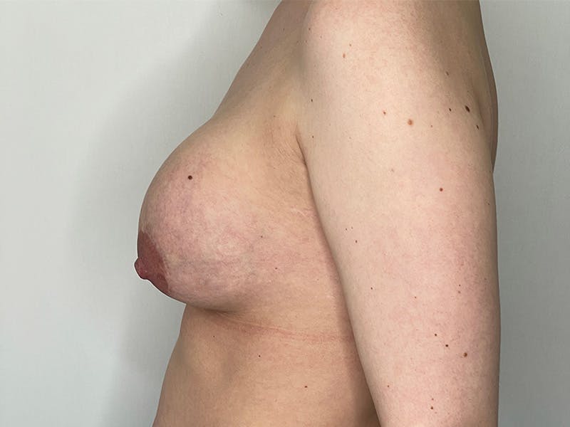 Exchange of Breast Implants Before & After Gallery - Patient 141597226 - Image 1