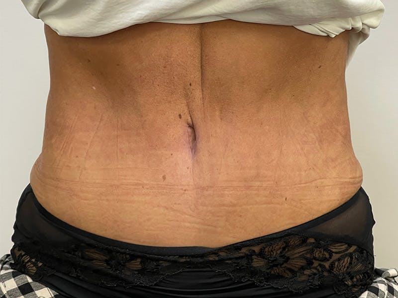Liposuction Before & After Gallery - Patient 141597238 - Image 2