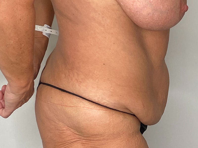 Liposuction Before & After Gallery - Patient 141597238 - Image 3