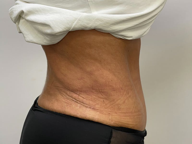 Liposuction Before & After Gallery - Patient 141597238 - Image 4