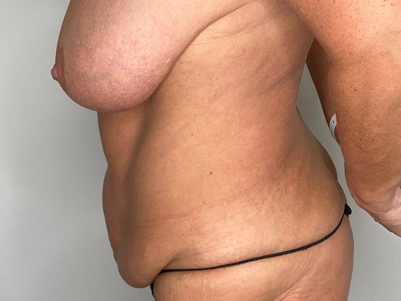 Liposuction Before & After Gallery - Patient 141597238 - Image 5