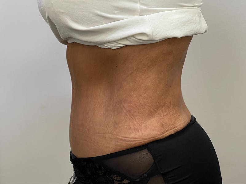 Liposuction Before & After Gallery - Patient 141597238 - Image 6