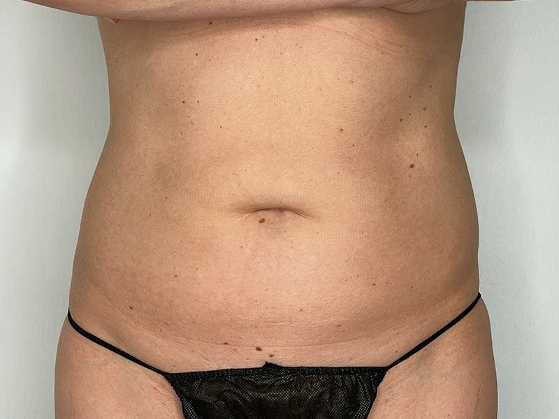 Liposuction Before & After Gallery - Patient 141597240 - Image 1