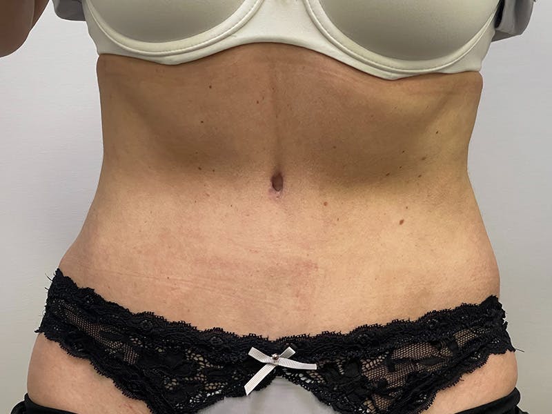Liposuction Before & After Gallery - Patient 141597240 - Image 2