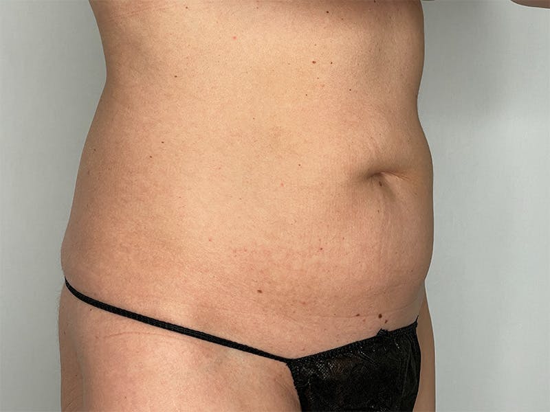 Liposuction Before & After Gallery - Patient 141597240 - Image 3