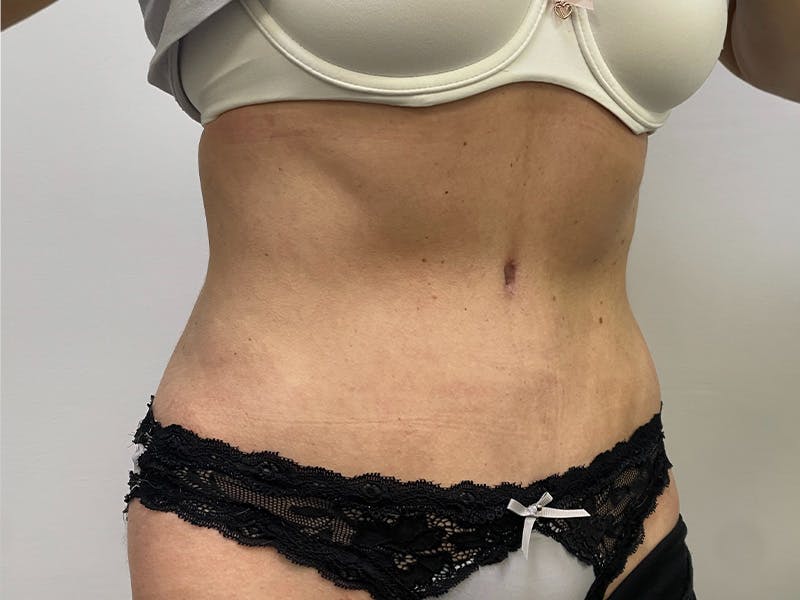 Liposuction Before & After Gallery - Patient 141597240 - Image 4