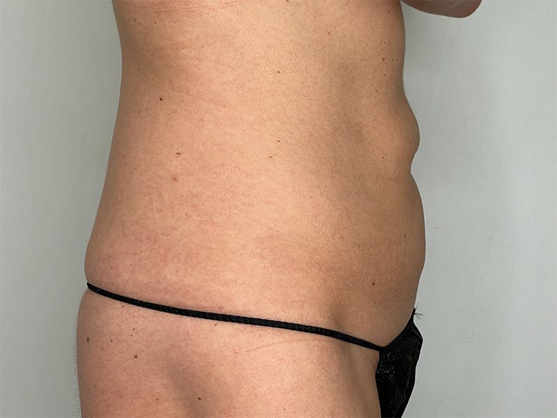 Liposuction Before & After Gallery - Patient 141597240 - Image 5