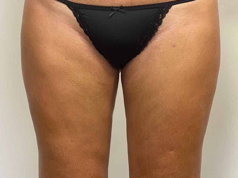 Liposuction Before & After Gallery - Patient 141597239 - Image 2