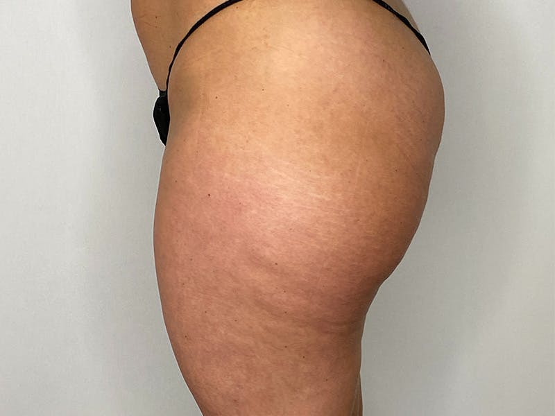 Liposuction Before & After Gallery - Patient 141597243 - Image 1