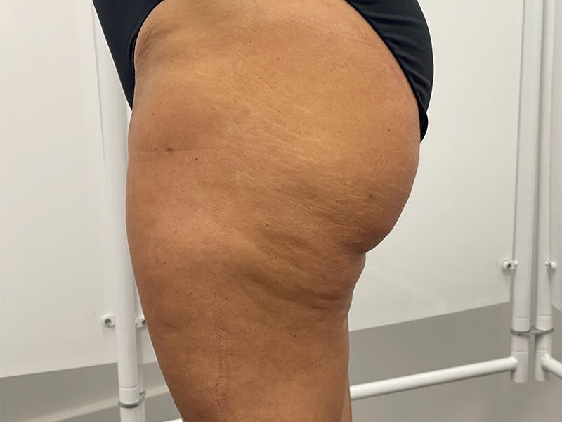 Liposuction Before & After Gallery - Patient 141597243 - Image 2